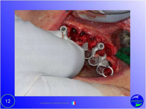 Mise en chage imm diate 012 ih2lwc - Eugenol