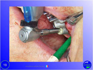 Mise en chage imm diate 019 jd3x7j - Eugenol