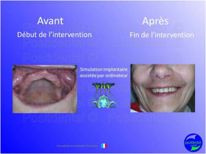Mise en chage imm diate 026 mhxry4 - Eugenol