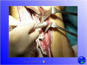 Mise en chage imm diate 040 vgxsvr - Eugenol