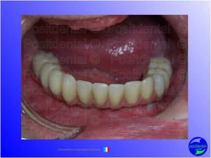 Mise en chage imm diate 042 f6xtsu - Eugenol