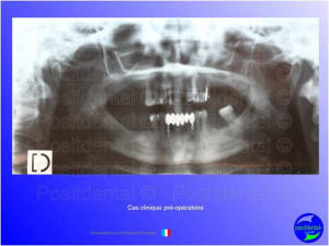 Mise en chage imm diate 054 oamegu - Eugenol