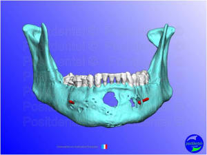 Mise en chage imm diate 062 lsailb - Eugenol