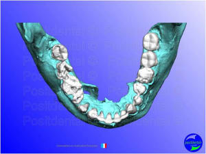Mise en chage imm diate 064 lxlbtu - Eugenol
