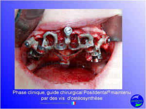 Mise en chage imm diate 110 cwdf1v - Eugenol