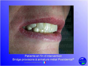 Mise en chage imm diate 115 fojtos - Eugenol