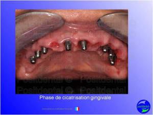Mise en chage imm diate 116 lryfod - Eugenol