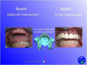 Mise en chage imm diate 128 xkc8hr - Eugenol