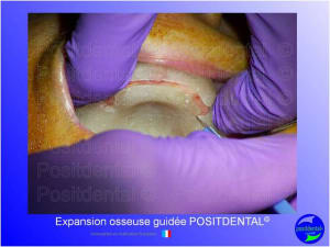 Mise en chage imm diate 130 u5jneo - Eugenol