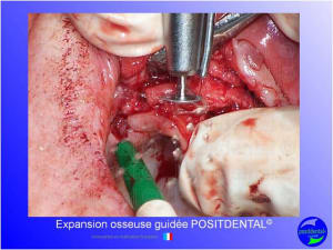 Mise en chage imm diate 145 dxkyzi - Eugenol