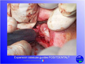 Mise en chage imm diate 147 zgyp6b - Eugenol