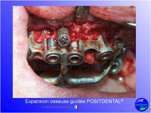 Mise en chage imm diate 156 j7lib8 - Eugenol