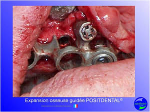 Mise en chage imm diate 158 ozd0dy - Eugenol