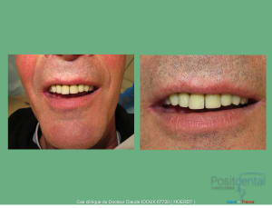 Mise en charge immédiade c - Eugenol