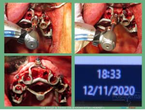 Mise en charge immédiade c - Eugenol