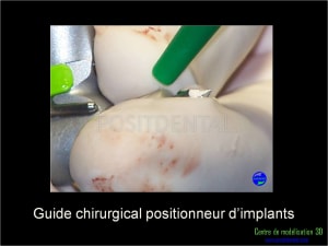 Mise en charge immédiate implant dentaire 035 i0quk4 - Eugenol