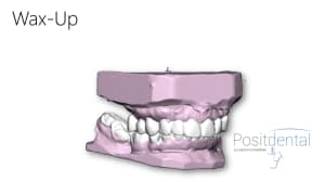 Mise en charge innédiate positdental 003 b2ivf5 - Eugenol