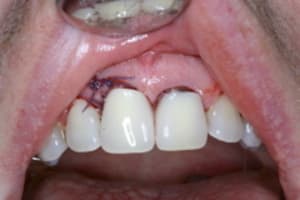 Pap t1svgf - Eugenol
