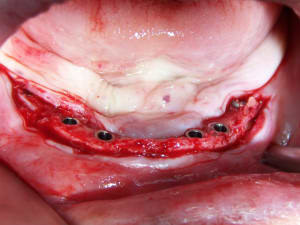 Positdental 14 08 19 049 lrag1n - Eugenol