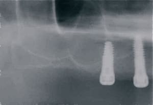 Pano post op kf0tgu - Eugenol