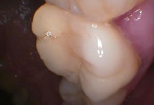 Patient 9 wdavdb - Eugenol