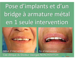 Pose d implants et d un bridge à armature métal en 1 seule intervention g - Eugenol