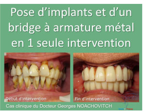 Pose d implants et d un bridge à armature métal en 1 seule intervention g - Eugenol