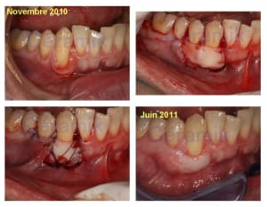 Post op greffe uvlb1e - Eugenol