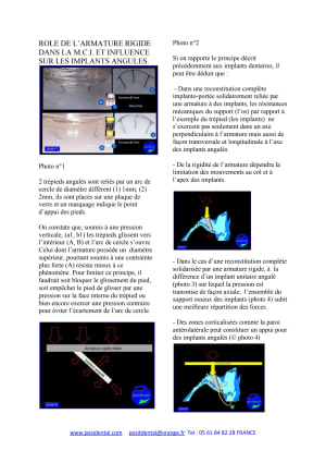 Role de l armature rigide dans la mci et influence sur les implants angules - Eugenol
