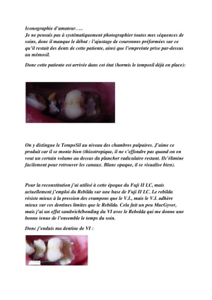 Reconstitution avant pose de digue plncae - Eugenol