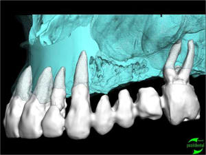 Simullation implantaire assist e par ordinateur positdental 008 viuq8v - Eugenol