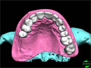 Simullation implantaire assist e par ordinateur positdental 014 qvtdgt - Eugenol