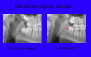 T l  radio 1 et 2 agrandissement bfj76c - Eugenol
