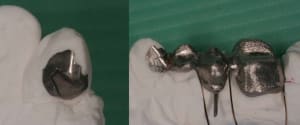 Taquets occlusaux 1 wvmf3t - Eugenol