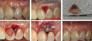 Traitement pigmentation gingivale v599ct - Eugenol