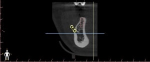 Untitled1 coronal view kq7s0w - Eugenol