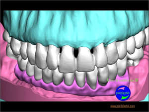 Wax up 3d positdental 15 mdixrj - Eugenol