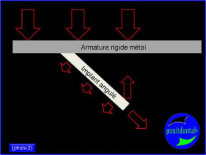 Armature m tal rigide pour mci positdental 2 uvkvoo - Eugenol