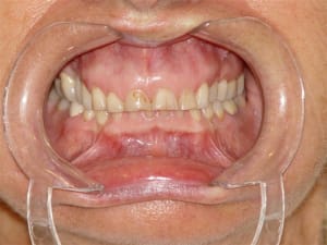 Avant traitement u2cypp - Eugenol