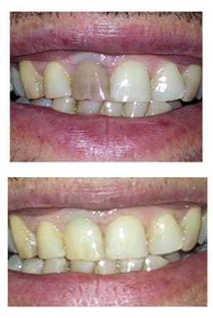 Blanchiement int 11 av ap.. - Eugenol