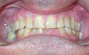 Bouche ixwby2 - Eugenol