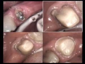 Bridge c pvmsv6 - Eugenol