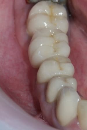 Bridge déf2 euflpr - Eugenol