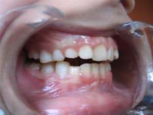 Cales hsdrts - Eugenol