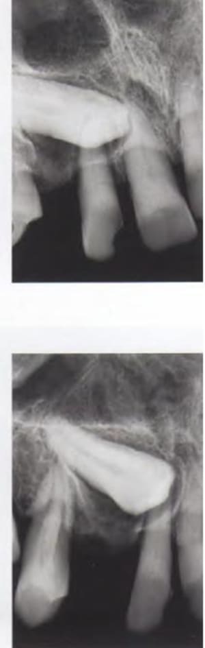 Canines palat b2qxer - Eugenol