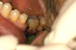 Carie sous gingivale 001  1  kjb56d - Eugenol