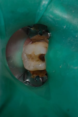 Cavite finie jwvbge - Eugenol
