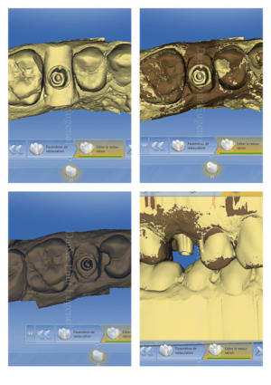 Cerec 2 e1dcpo - Eugenol