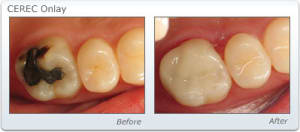 Cerec onlay yuvznx - Eugenol