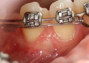 Cicatrisation duwhwd - Eugenol